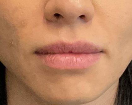 Patient Lip Filler Before And After Photos Austin Tx Plastic