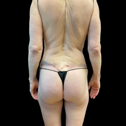 Butt Lift Before & After Patient #8109