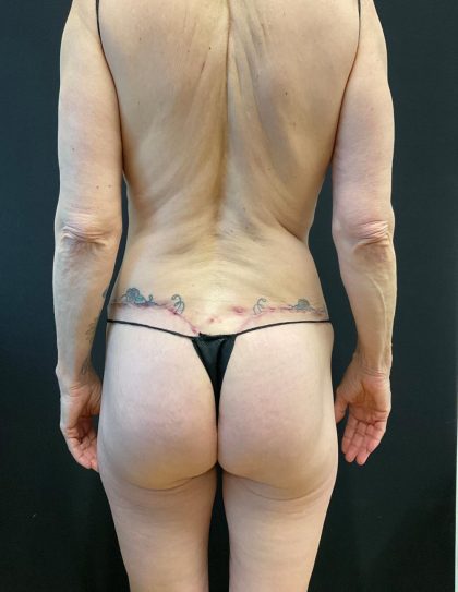 Butt Lift Before & After Patient #8109