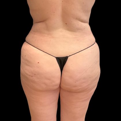 Brazilian Butt Lift Before & After Patient #9177