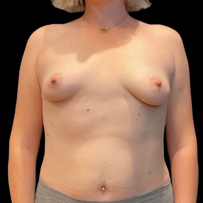 Breast Augmentation Before & After Patient #9278