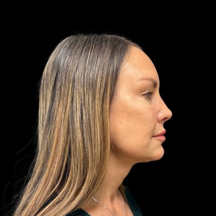 Rhinoplasty Before & After Patient #9157