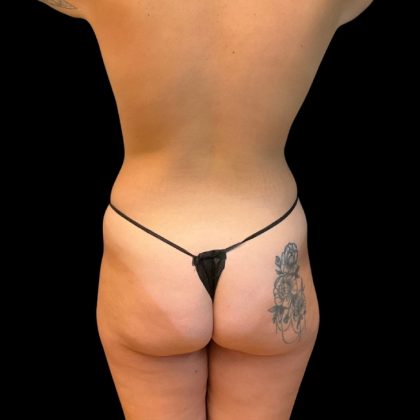 Brazilian Butt Lift Before & After Patient #10244