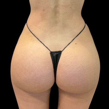 Brazilian Butt Lift Before & After Patient #10012