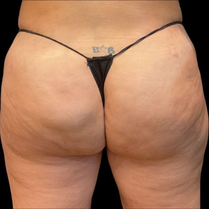 Brazilian Butt Lift Before & After Patient #10138