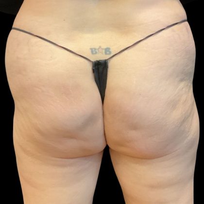 Brazilian Butt Lift Before & After Patient #10138