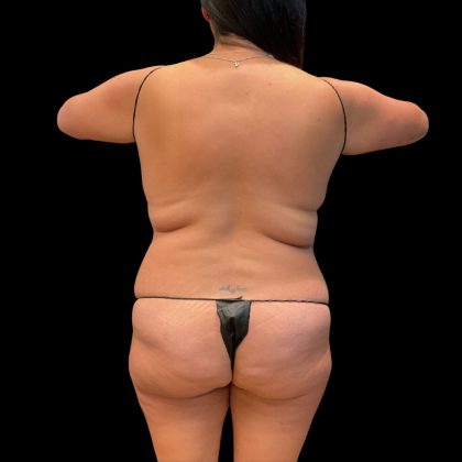 Brazilian Butt Lift Before & After Patient #10323