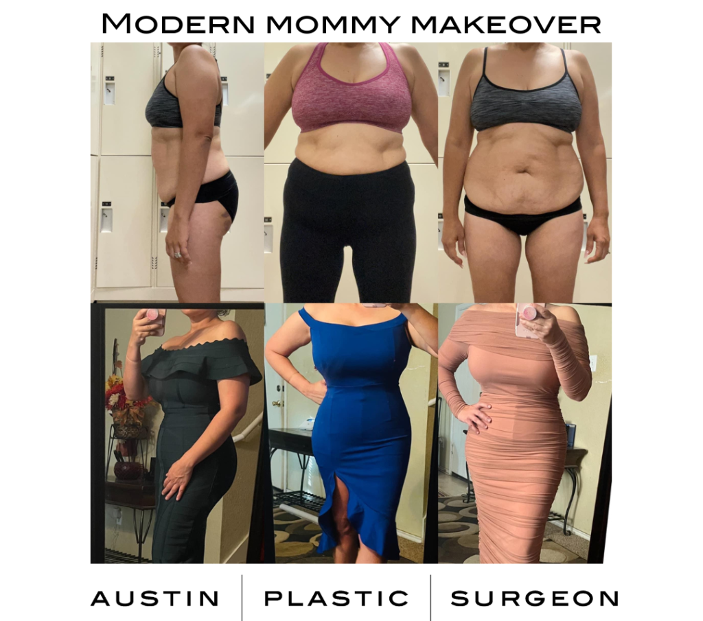 Mommy Makeover Austin